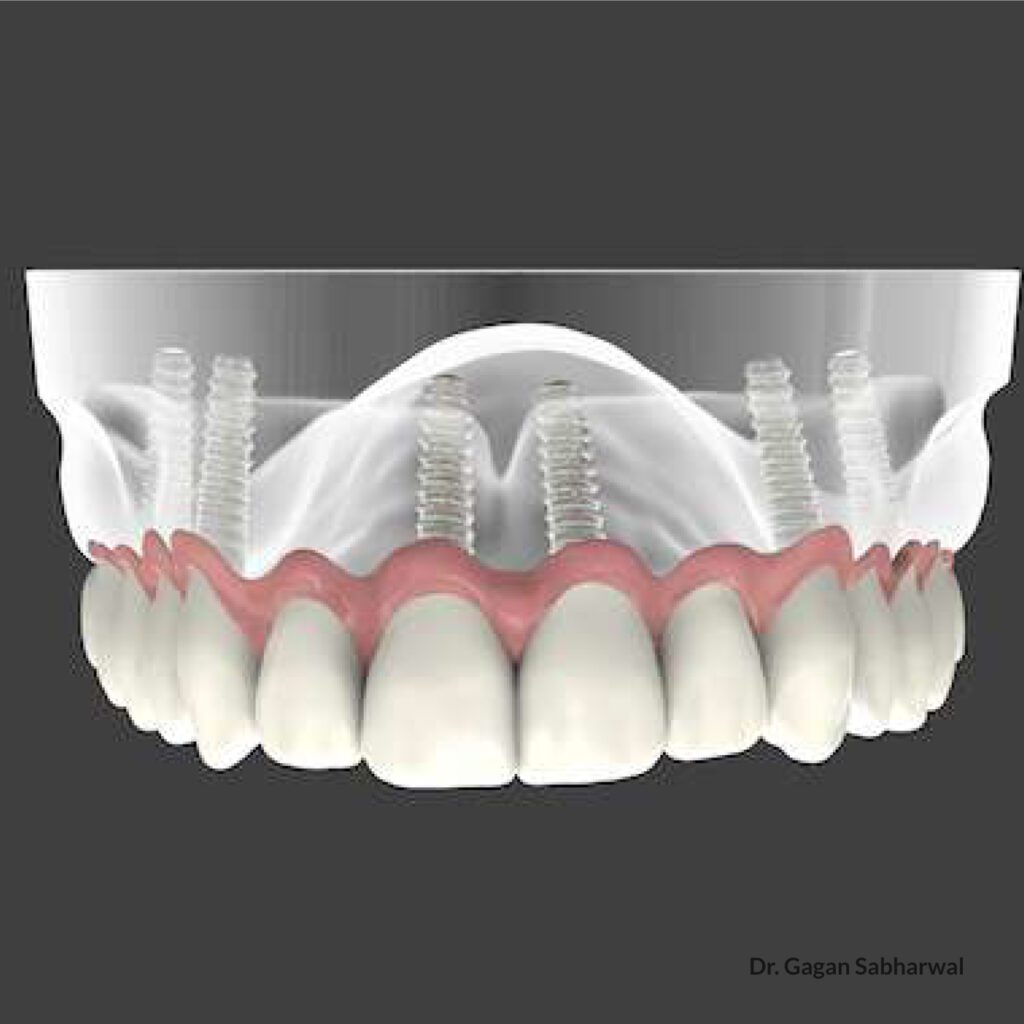 memphis sinus lift