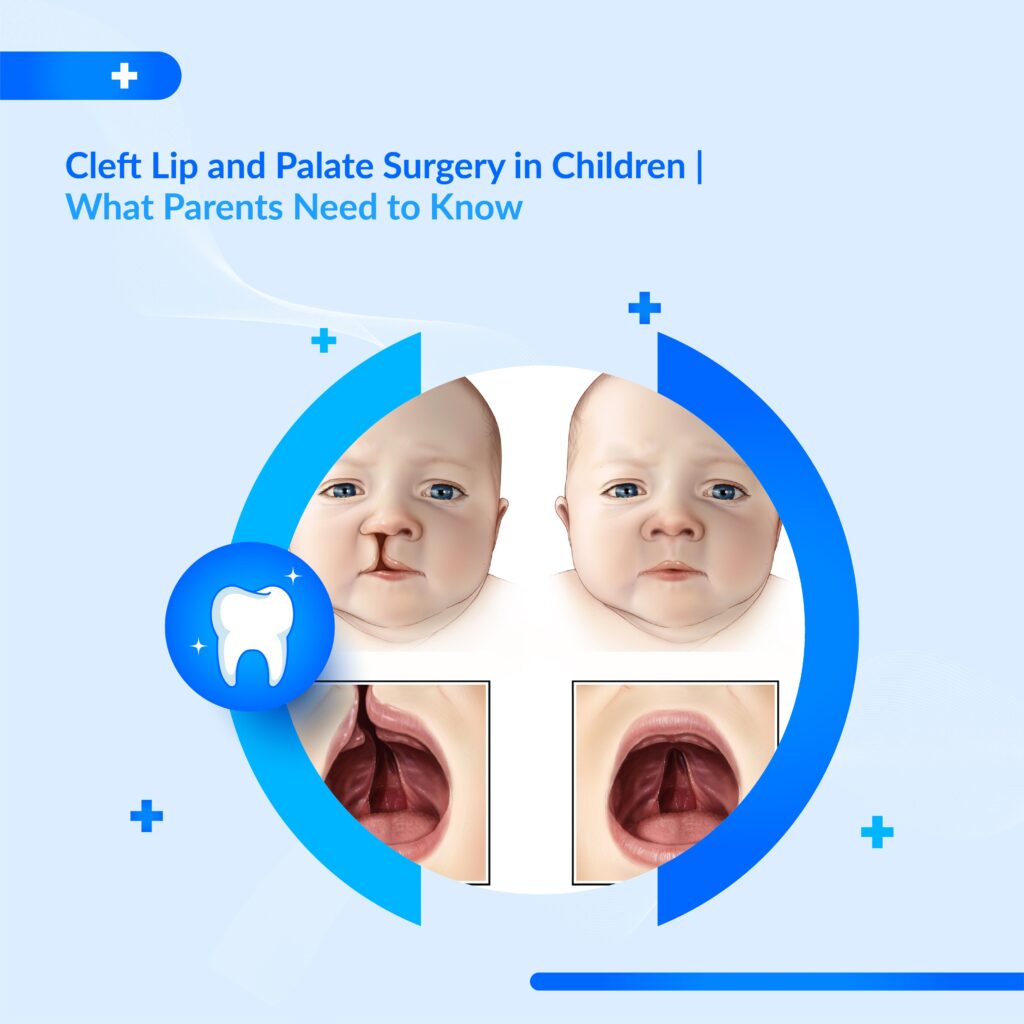 Cleft Lip and Palate Surgery in Children | What Parents Need to Know