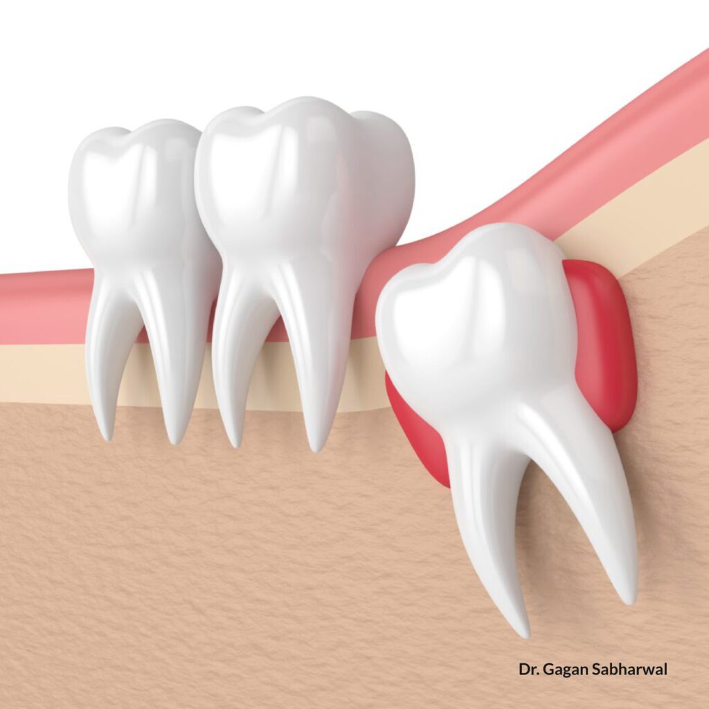 Wisdom Tooth causes