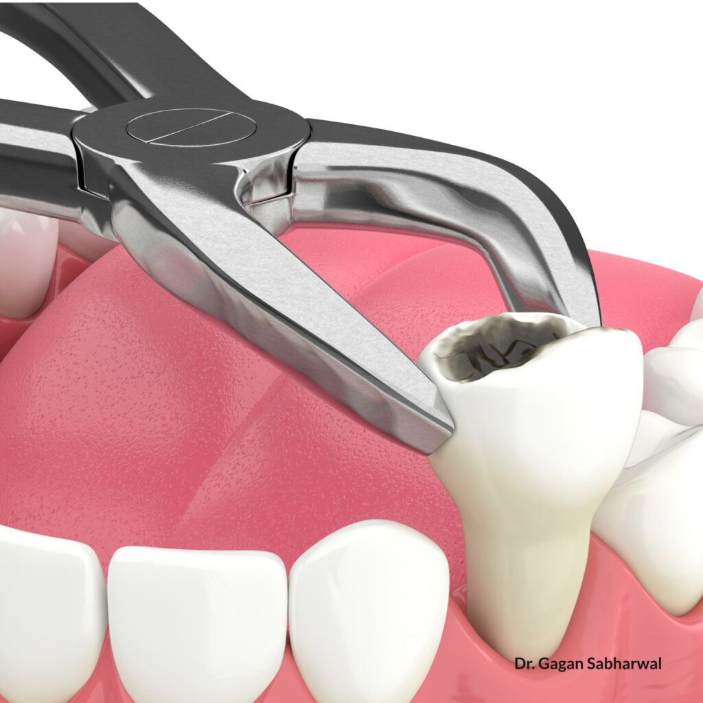 Impacted wisdom tooth symptoms