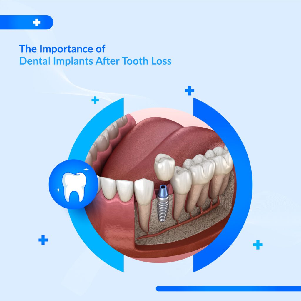 Dental Implants After Tooth Loss | Benefits & Replacement