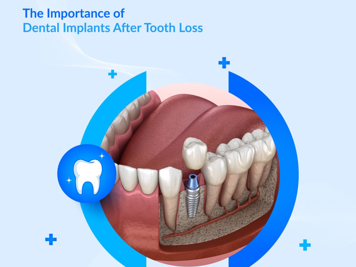 Dental Implants After Tooth Loss | Benefits & Replacement