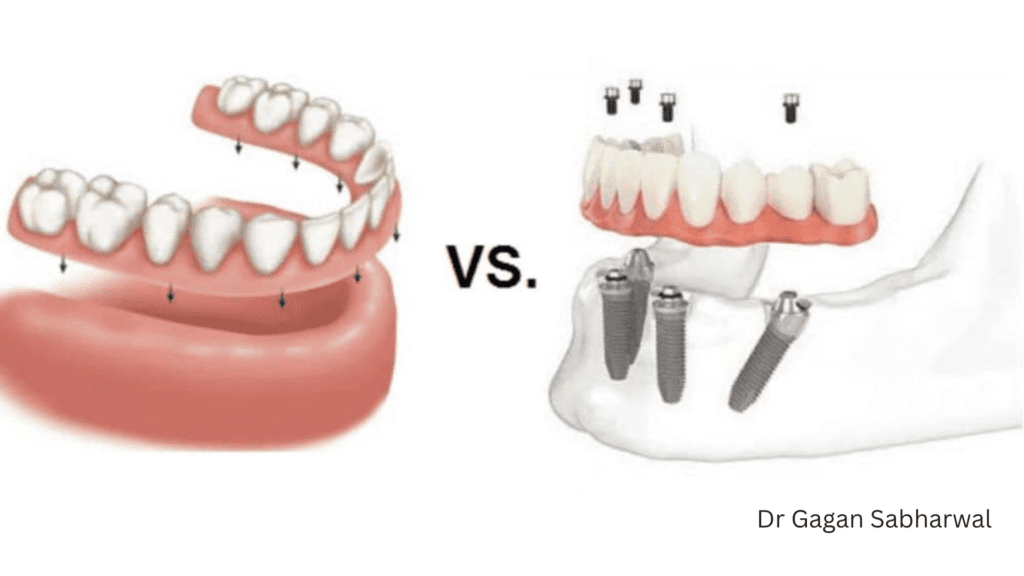 dentures vs implants

