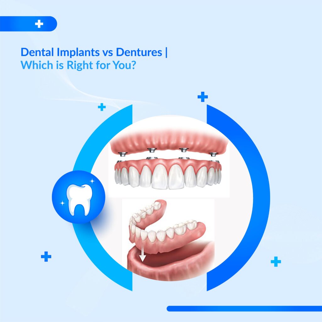 Dentures vs Implants: Best Missing Teeth Solution