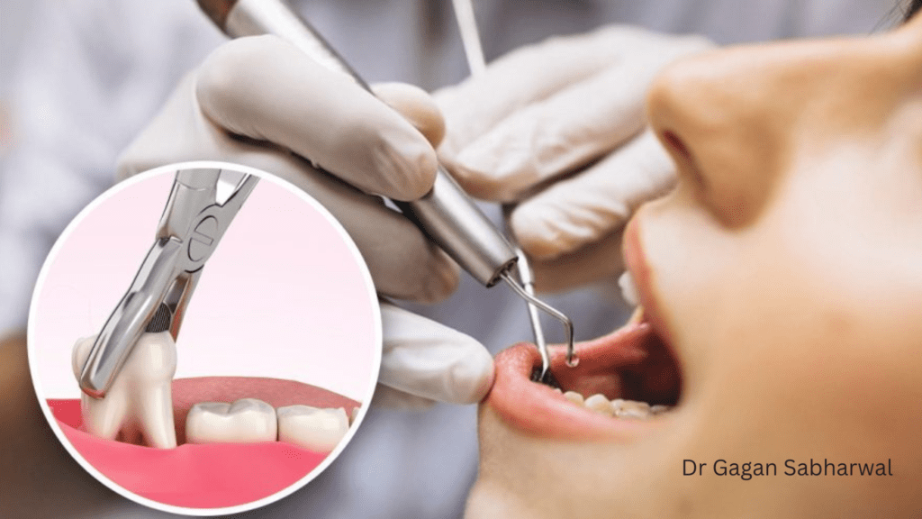 impacted wisdom tooth