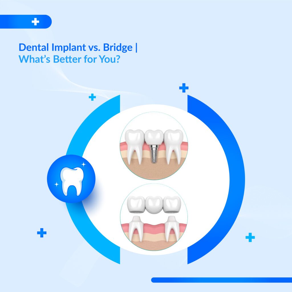tooth replacement options