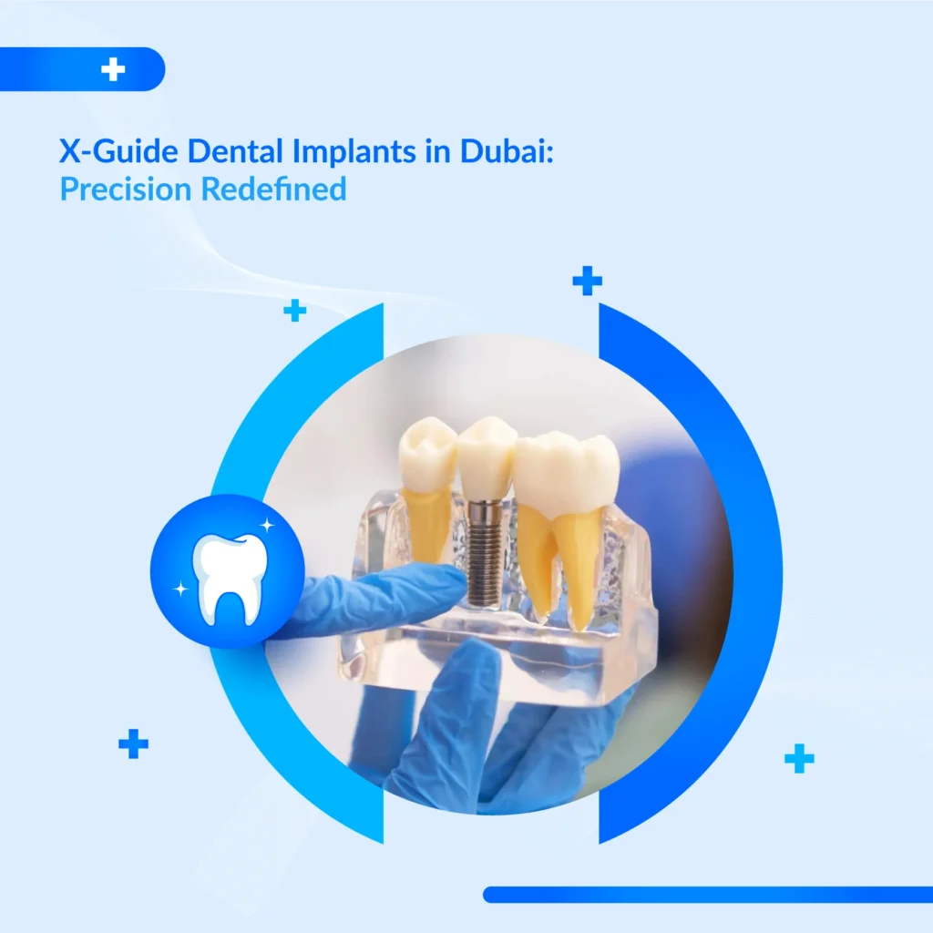 X-Guide dental implants