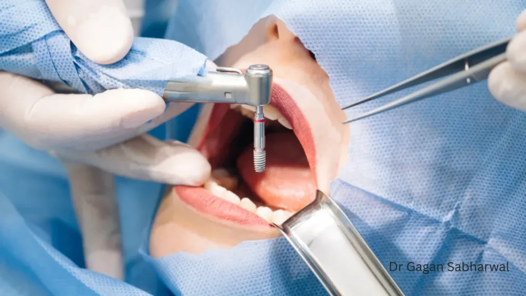 Same-day dental implants Dubai Dr Gagan Sabharwal