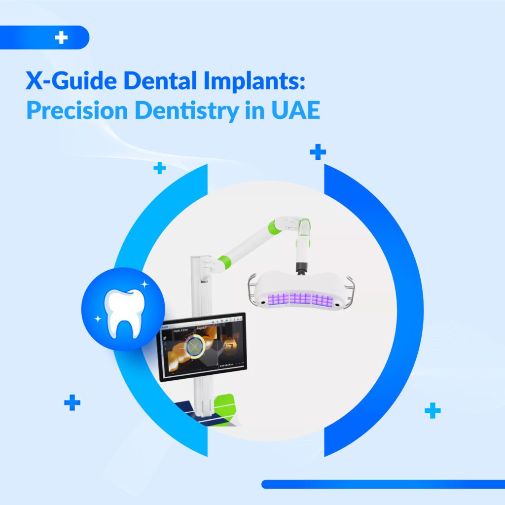 X-Guide dental implants