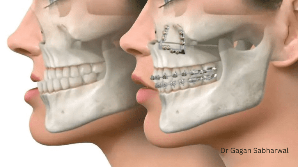 corrective jaw surgery Dubai Dr Gagan Sabharwal