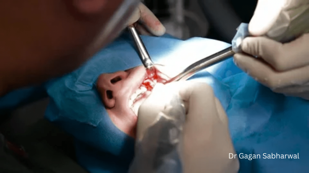 dental bone graft UAE