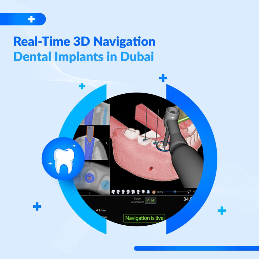 X-Guide implant system