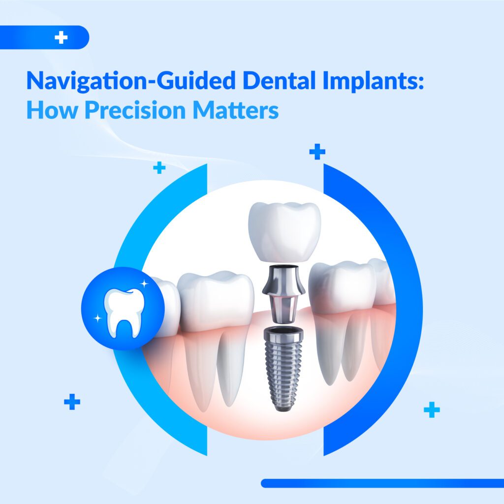 navigation-guided dental implants