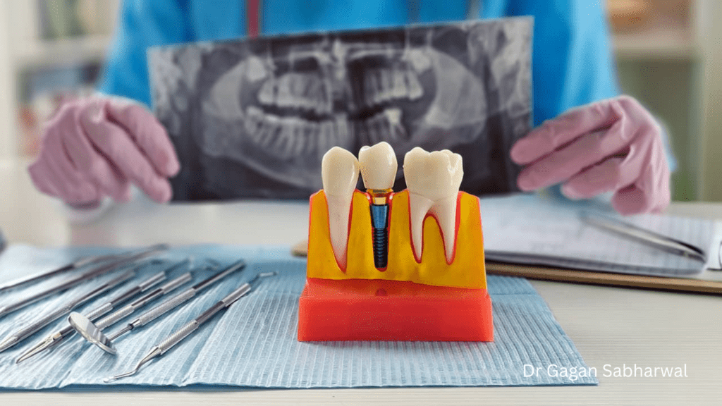 X-Guide dental implants