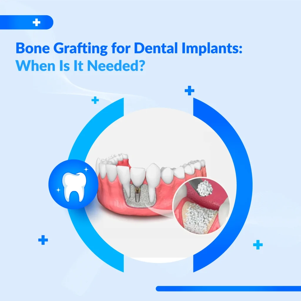 Bone Grafting for Dental Implants