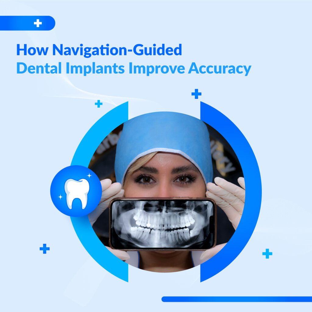 X-Guide dental implants