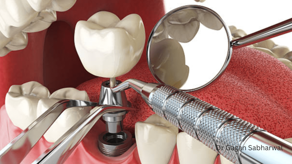 Navigation-guided dental implants
