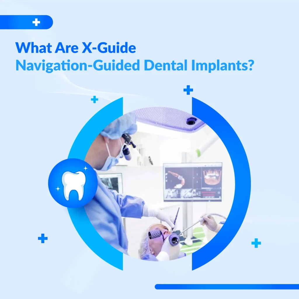 Navigation-guided dental implants