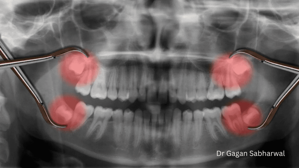 Wisdom Tooth Pain Management