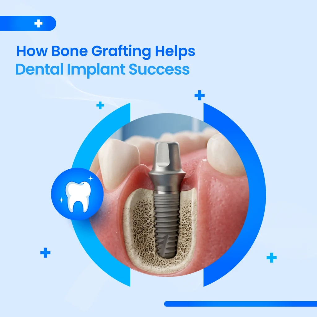 Bone Grafting Specialist Dubai