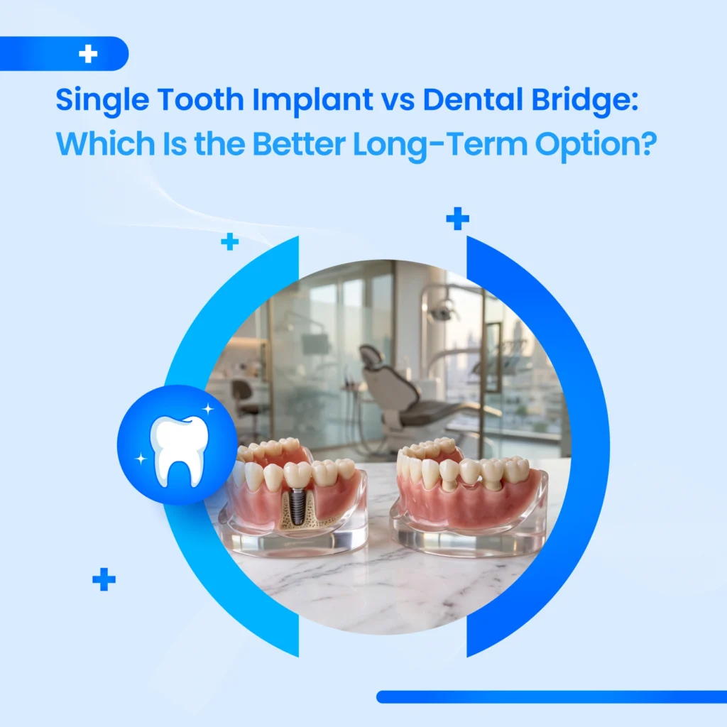 Single Tooth Implant Cost Dubai